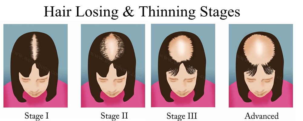 hair losing and thinning stages